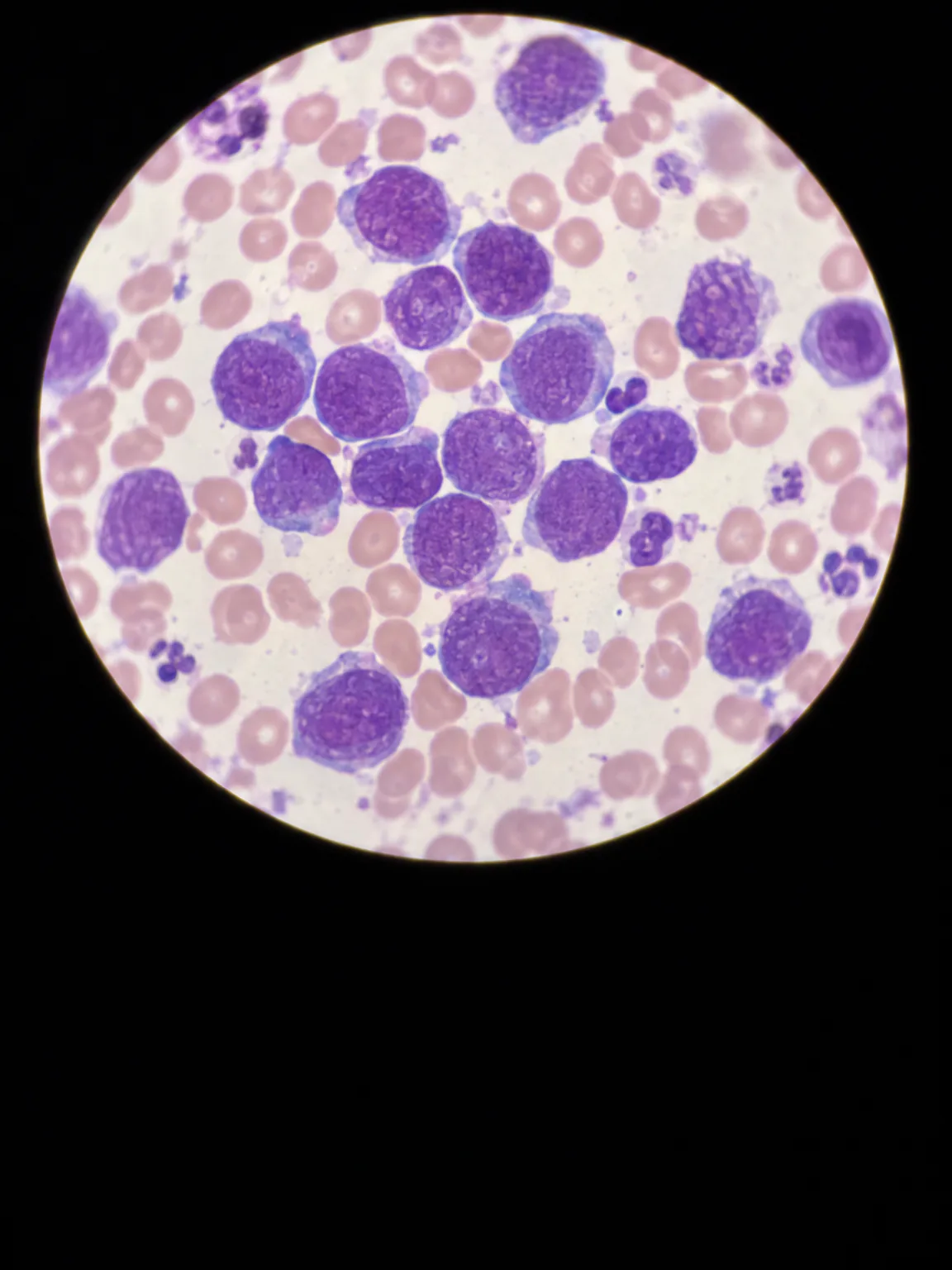 Illustration: a stained blood smear seen through a microscope, with large violet leukemia cells among red blood cells