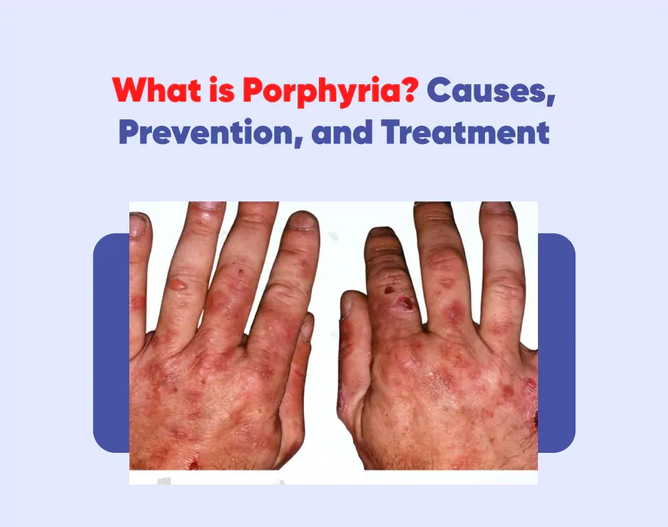 What is Porphyria? Causes, Prevention, and Treatment