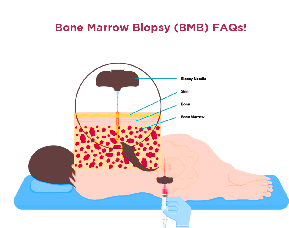 Bone Marrow Biopsy (BMB) FAQs!