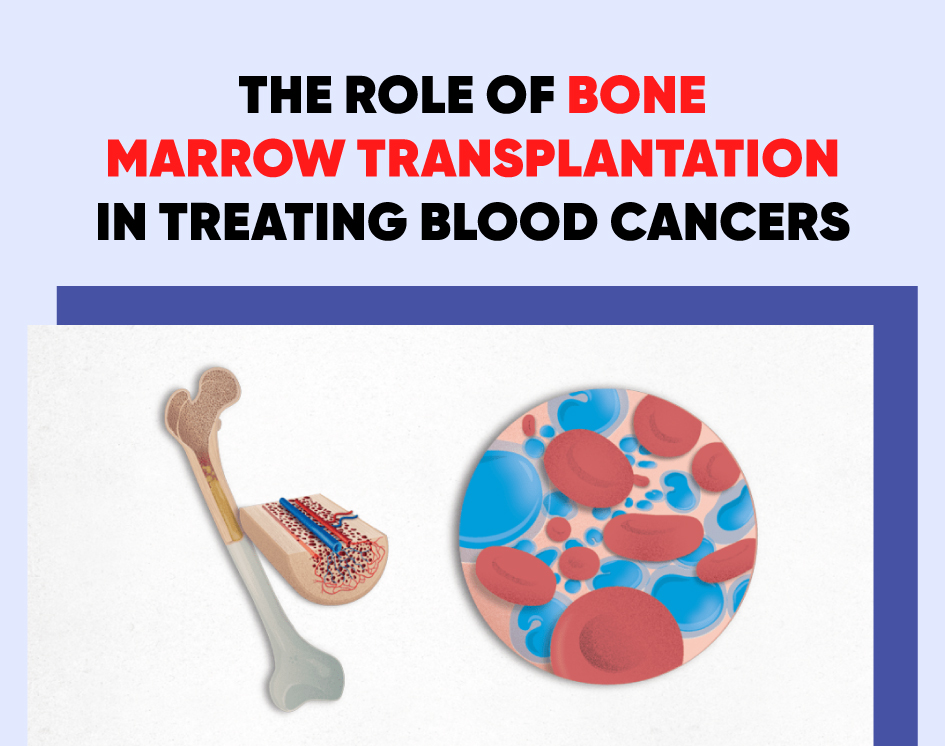 The Role of Bone Marrow Transplantation in Treating Blood Cancers