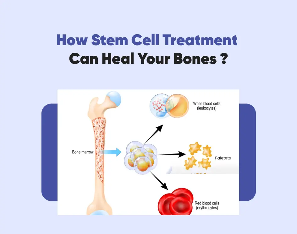 How Stem Cell Treatment Can Heal Your Bones ?