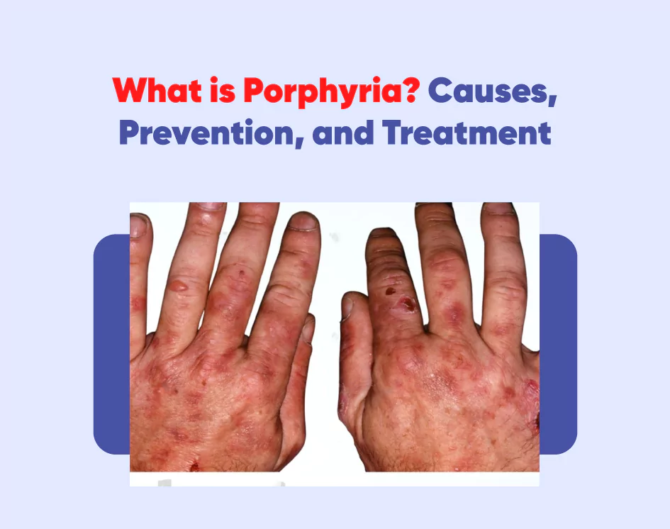 What is Porphyria? Causes, Prevention, and Treatment
