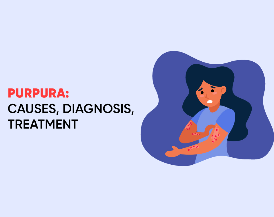 All You Need to Know About Purpura: Causes, Diagnosis, Treatment