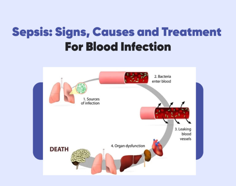 Sepsis: Signs, Causes and Treatment For Blood Infection