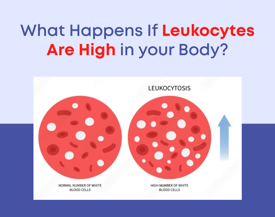 What Happens If Leukocytes (White Blood Cells) Are High in your Body?