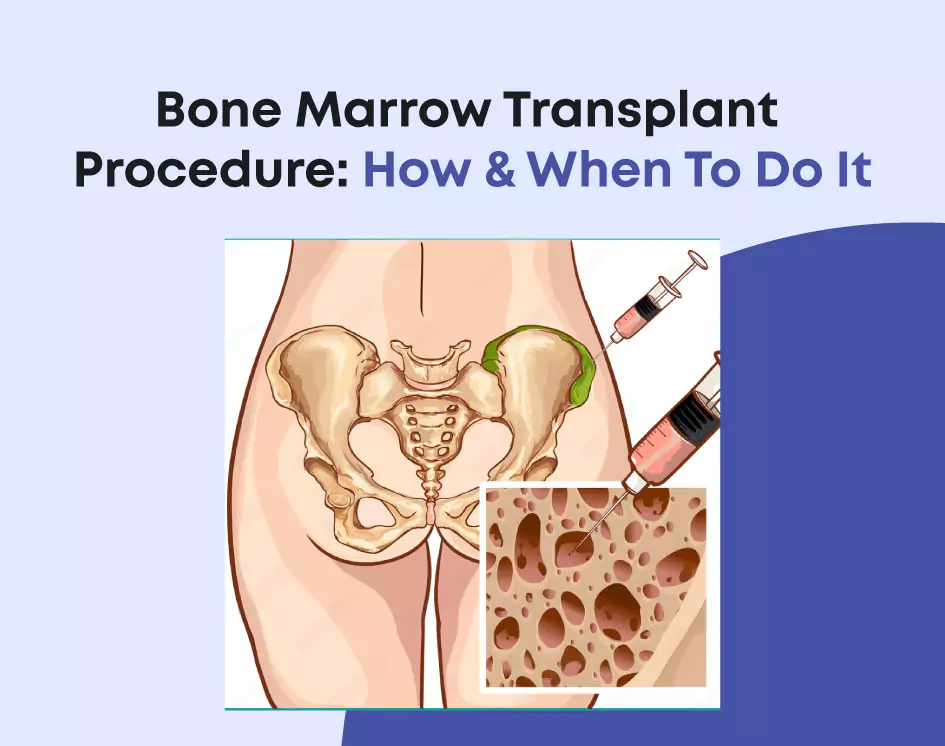 Bone Marrow Transplant Procedure: How & When To Do It?