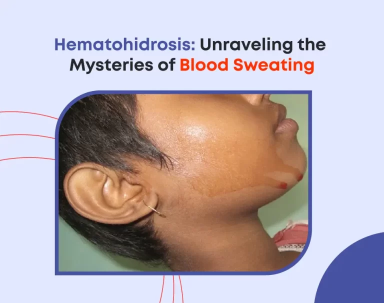 Hematohidrosis: Unraveling the Mysteries of Blood Sweating