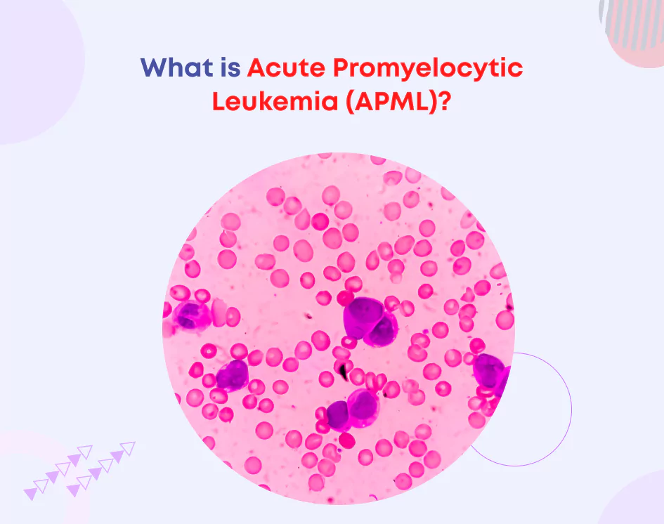 What is Acute Promyelocytic Leukemia (APML)?