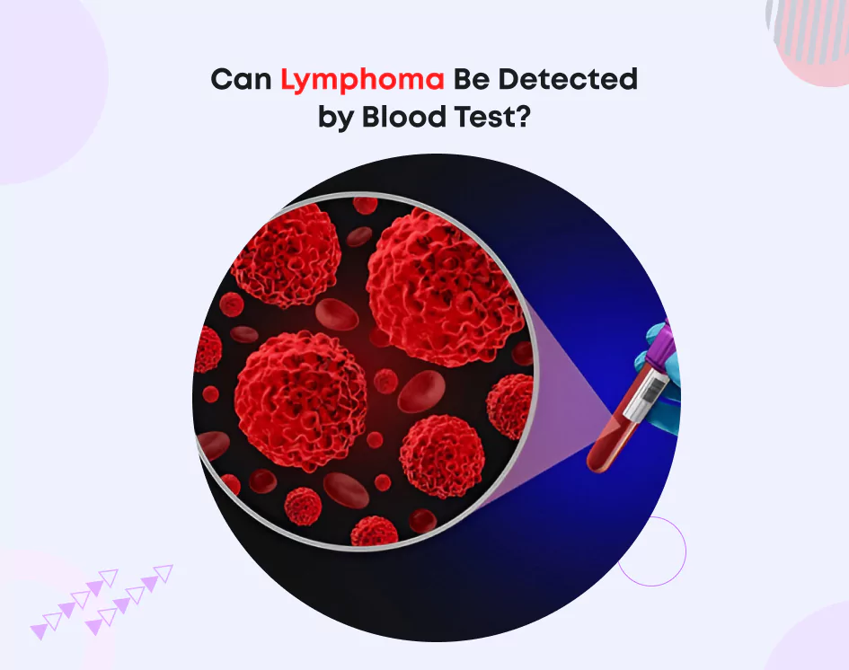 Can Lymphoma Be Detected by Blood Test? Can Lymphoma Be Detected by Blood Test?