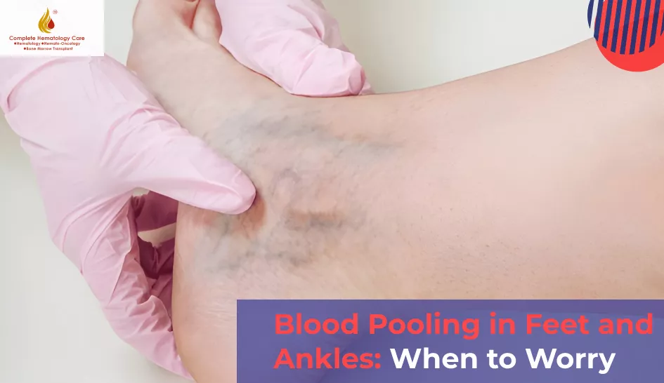 Blood Pooling in Feet and Ankles: Causes, Symptoms, and When to Worry